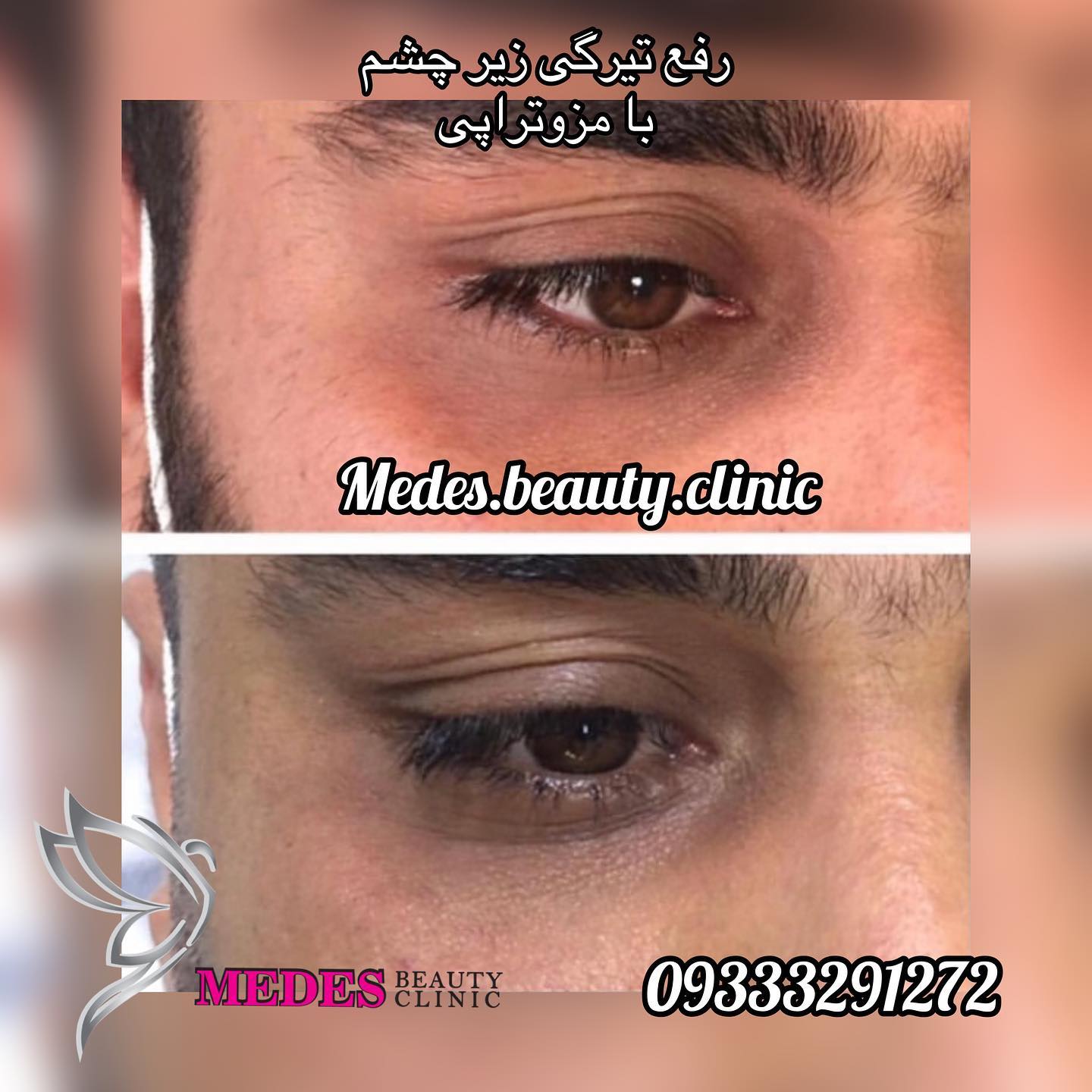 گالری مزوتراپی